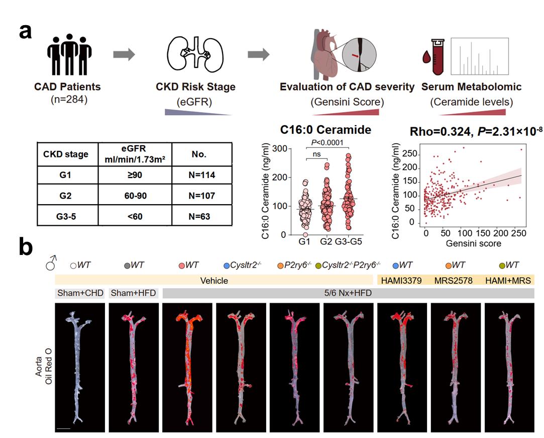 Nature! Researchers of Peking University and Shandong University Uncover Key Receptors Driving Atherosclerosis, Paving the Way for Targeted Therapies